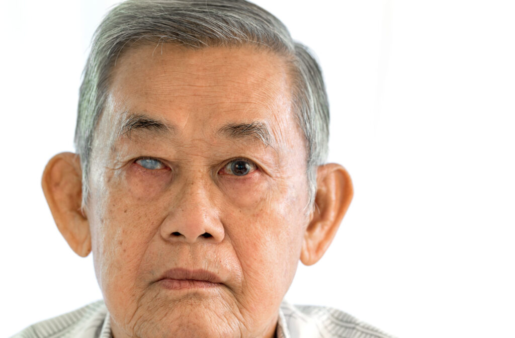 Close-up of a senior man with a serious expression and glaucoma in his right eye.