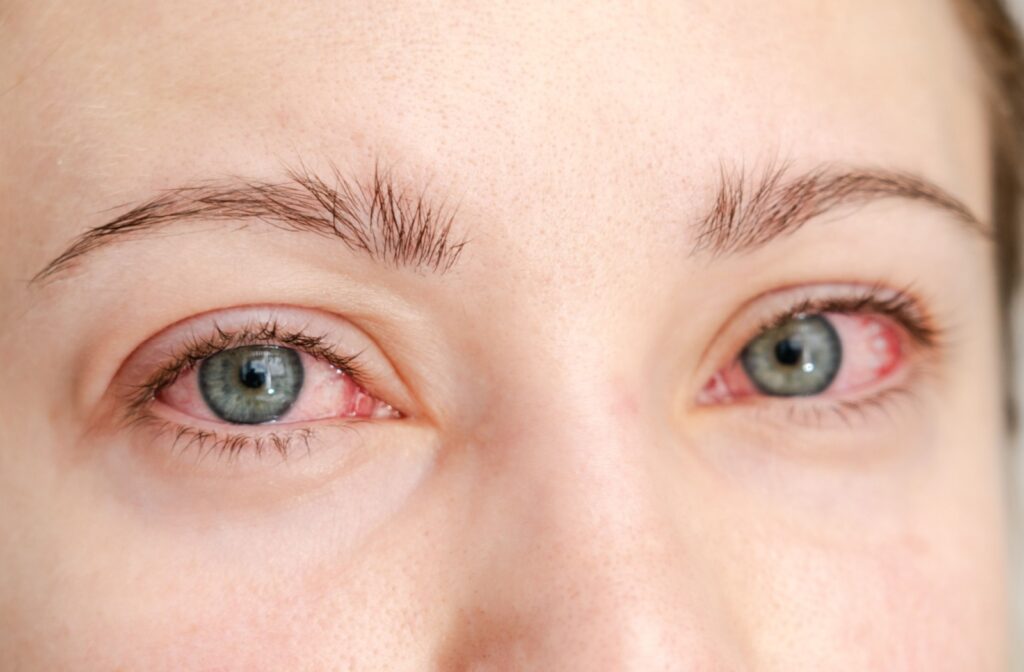 A close-up image of a person's bloodshot eyes showing symptoms of pink eye.