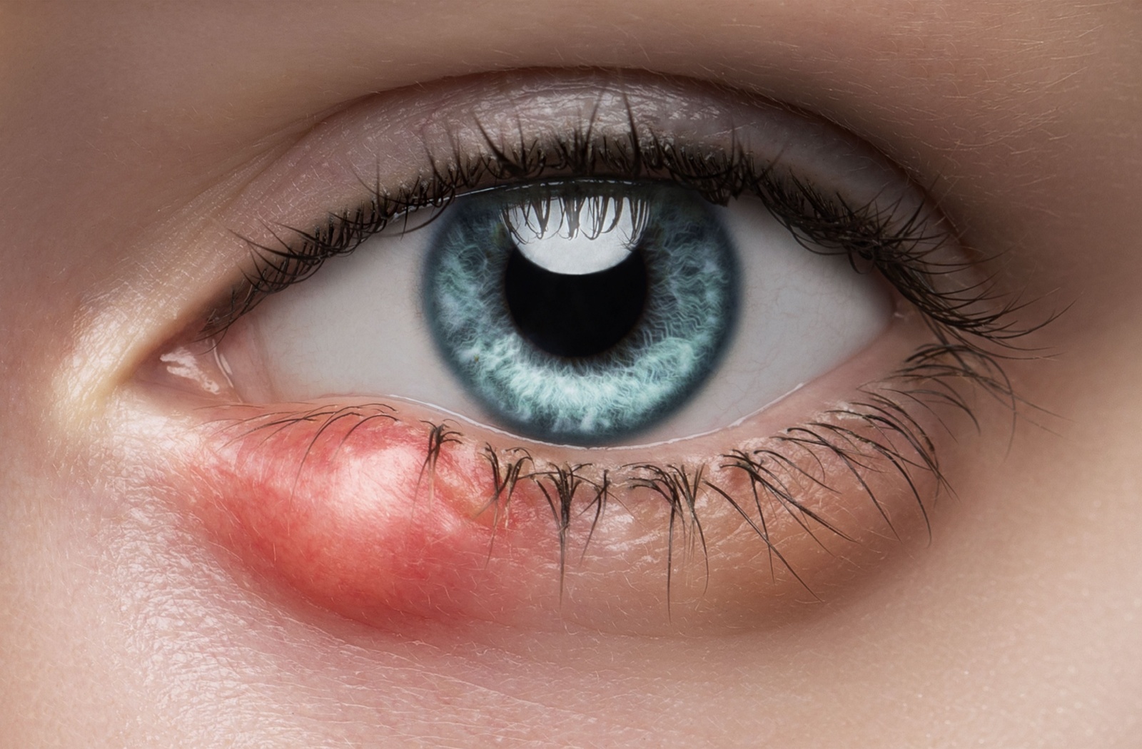 A close-up image of a blue eye with a large swollen stye on the lower eyelid.