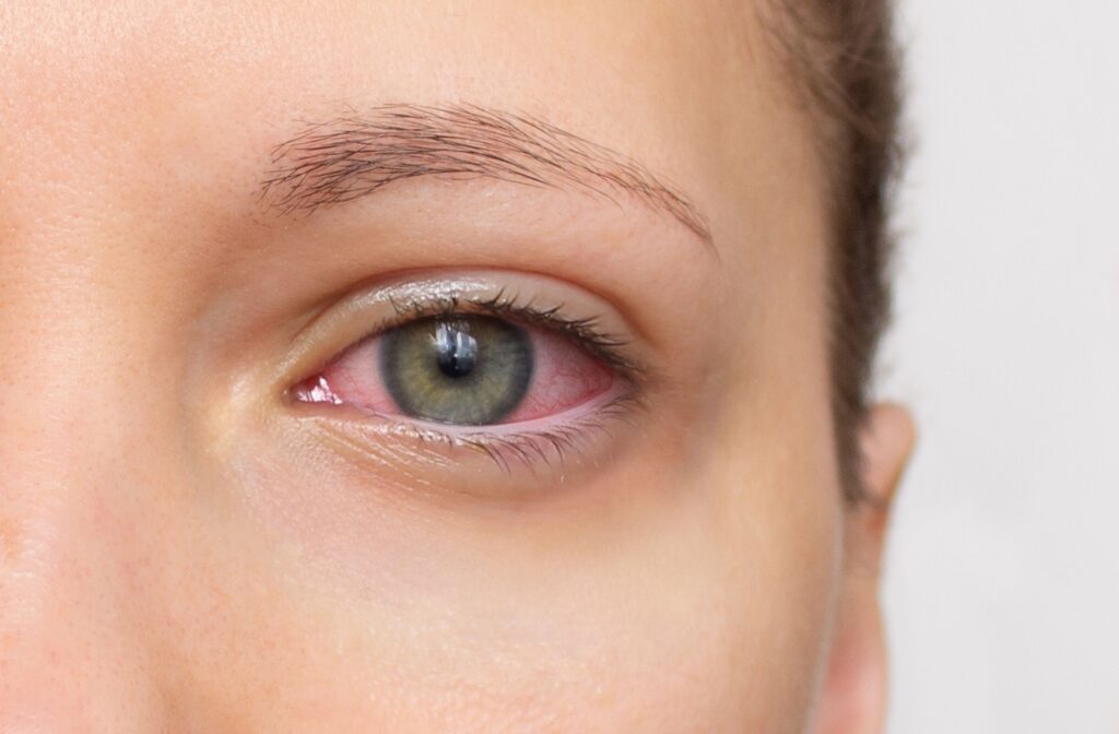 A close-up of a woman's red, dry eye.