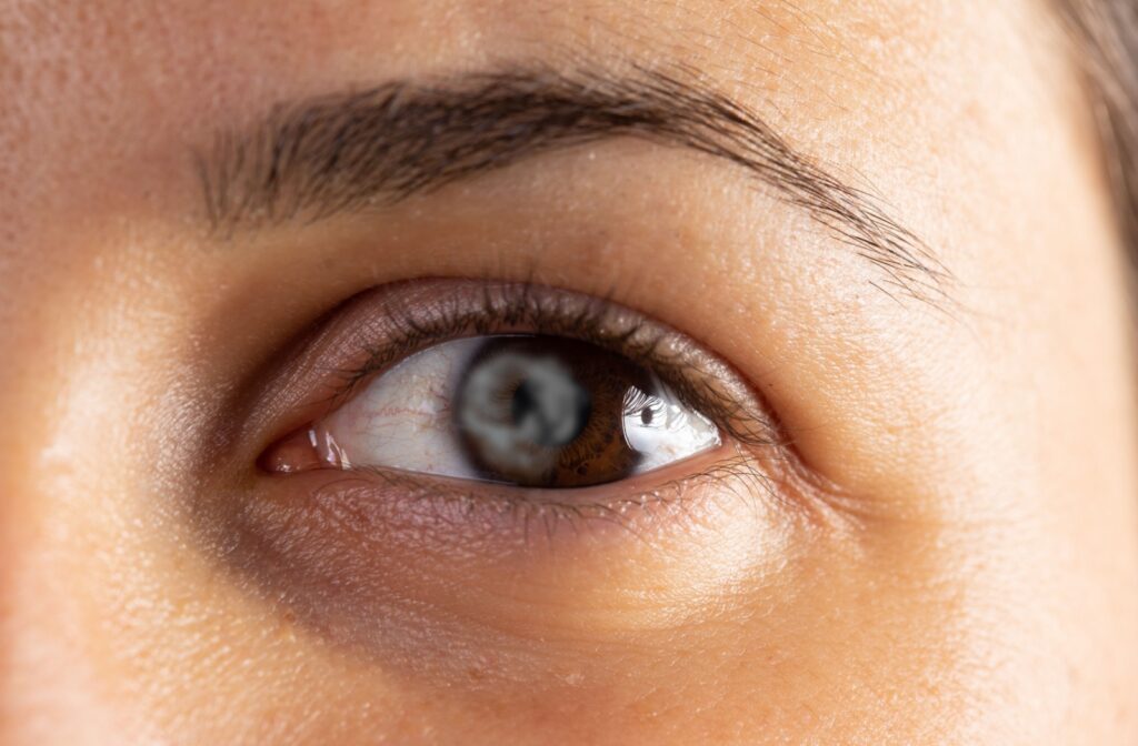 Close-up of a brown eye with a cloudy iris, symbolizing the effects of glaucoma.